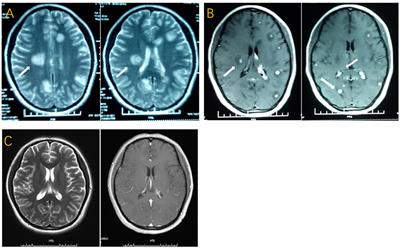 Case report: Multiple brain tuberculomas after in vitro fertilization, embryo transfer, and abortion